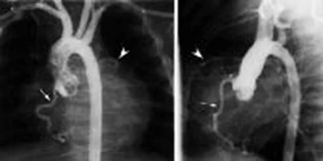 Аневризма перегородки у ребенка. Расслаивающаяся аневризма аорты рентген. Аневризма аорты рентген. Расслаивающая аневризма аорты аортография. Коарктация аорты рентген.