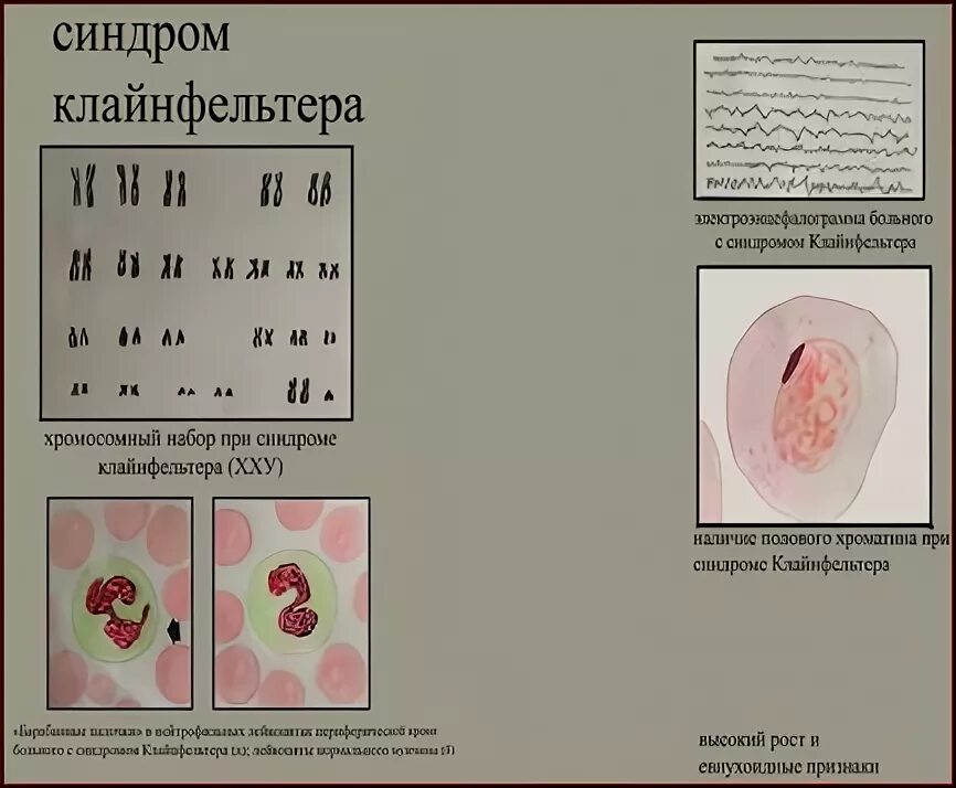 Синдром тельца. Синдром Клайнфельтера тельца Барра. Тельца Барра при синдроме Клайнфельтера. Половой хроматин при синдроме Клайнфельтера. Число Телец Барра при синдроме Клайнфельтера.