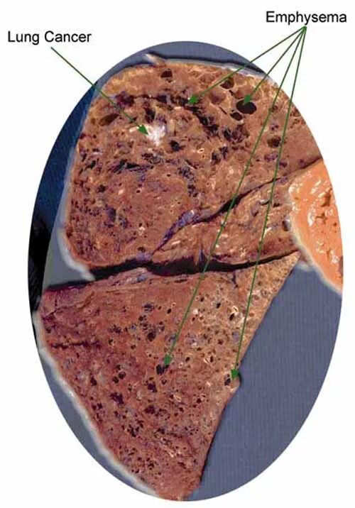 Как живут без легкого. Внутридольковая эмфизема. Острая очаговая эмфизема легких. Альвеолярная эмфизема. Эмфизема макропрепарат.