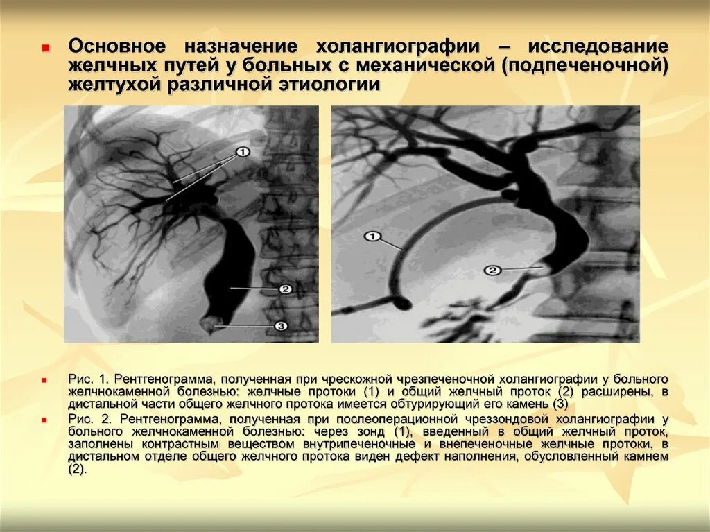 Исследование желчи. Холангиография рентген описание. Фистулография холангиография. Холангиография желчевыводящих путей. Исследование желчнвх протокола.