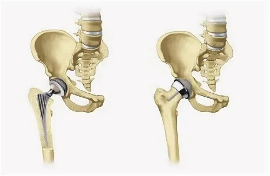 Эндопротезирование тазобедренного сустава Smith nephew. Коксартроз эндопротезирование тазобедренного сустава. Гемиартропластика тазобедренного сустава. Эндопротез шейки бедра. Операция замена сустава бедра