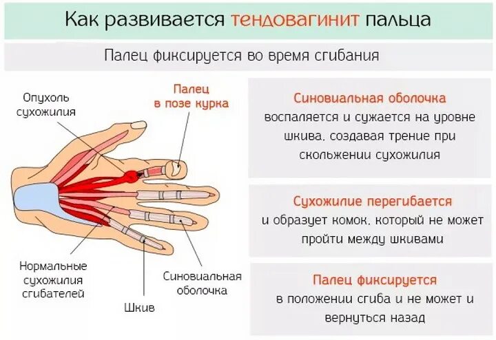 Сухожилия указательного пальца. Сустав указательного пальца. Сустав большого пальца руки.
