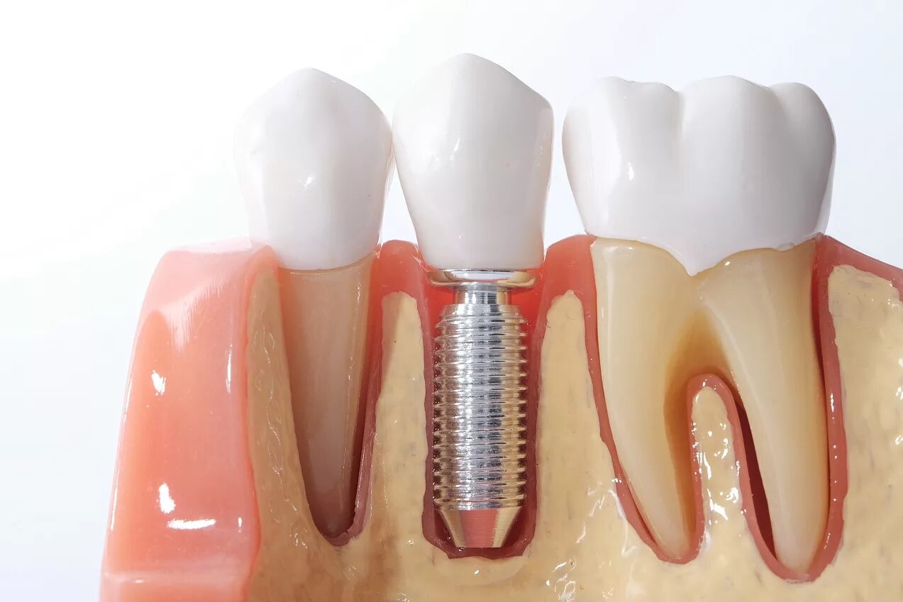 Три стоматолога. Внутрикостная дентальная имплантация. Керамические имплантаты зубные Штрауман. Одномоментная имплантация зуба.