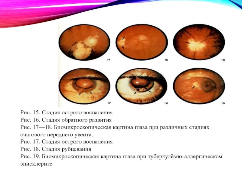 Стадия обратного развития