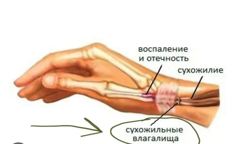 Ушиб 1 пальца мкб. Тендинит и тендовагинит. тендинит сухожилия пальца кисти. туберкулезный тендовагинит. тендовагинит сухожилий лучезапястного сустава.