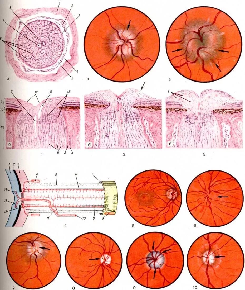 Что такое сосудистые пучки какую. Отечный диск зрительного нерва. Деколорация диска зрительного нерва. Проминирует диск зрительного нерва.