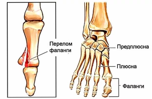 Основные фаланги стопы. Основная фаланга большого пальца стопы. Перелом костей фаланг пальцев ноги. Перелом проксимальной фаланги. Перелом плюсневой кости на ноге.