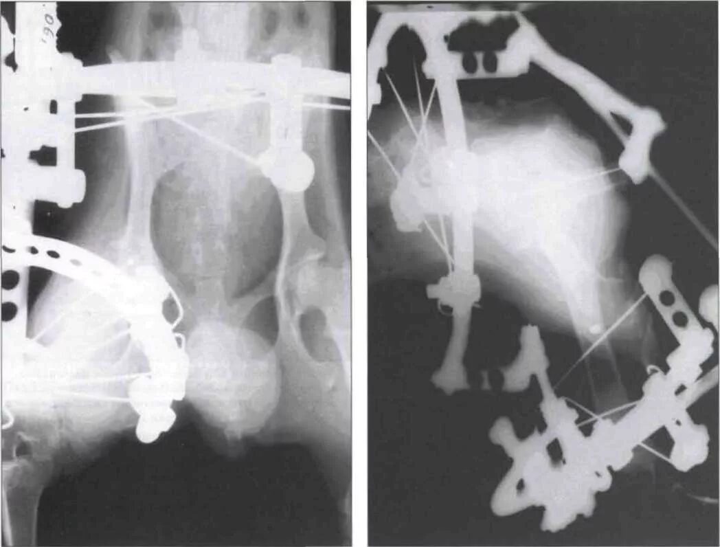 Наличия дисплазии. Аппарат Илизарова для перелома таза. Аппарат Илизарова на тазобедренный сустав. Перелом костей таза рентгенограмма.