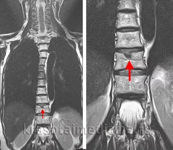 Грыжа шморля l1-l2. Замыкательная пластинка тела позвонка. Мрт позвоночника грыжа шморля. Th12-l1 позвонков грыжа шморля. Грыжа шморля поясничного отдела рентген.