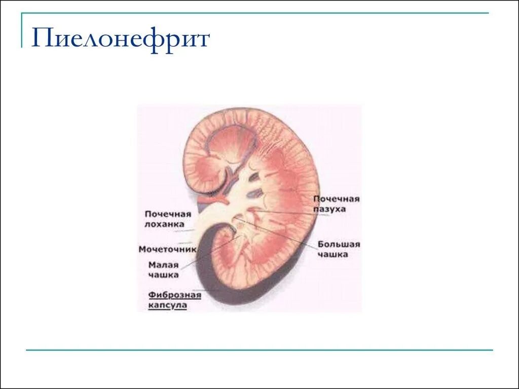 Строение почки при пиелонефрите. Острый двухсторонний пиелонефрит. Пиелонефрит презентация. Острый пиелонефрит презентация. Слизистые оболочки почек