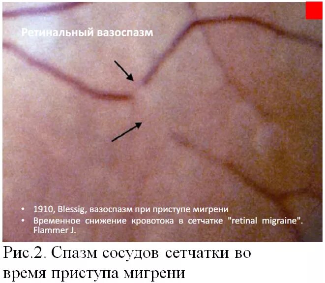 Спазма артерий сетчатки. Вазоспазм сосудов симптомы. Рефлекторный спазм сосудов. Почему спазм сосудов