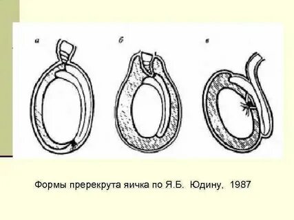 Перекрут канатика
