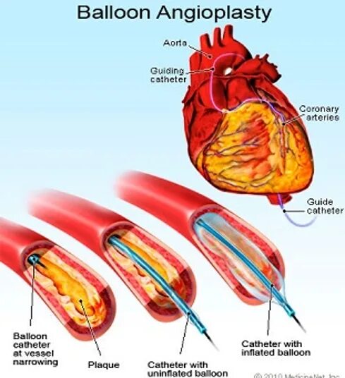 Баллонная коронарная ангиопластика. Коронарная ангиопластика. Баллонная ангиопластика артерий. Баллонная ангиопластика и стентирование. ТРАНСЛЮМИНАЛЬНАЯ коронарная ангиопластика.