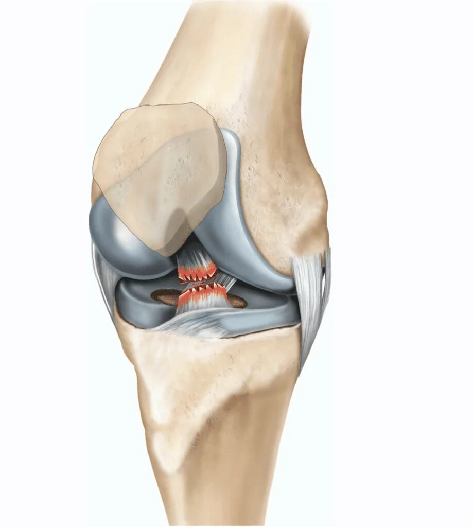 Разрыв крестообразной связки. Передняя крестообразная связка. Разрыв передней крестообразной связки. Крестовидная связка колена.