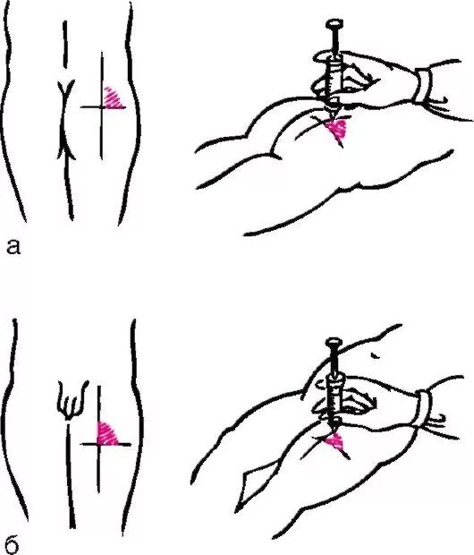 Как держать иглу. Внутримышечная инъекция в бедро техника. Внутримышечная инъекция места введения бедро. Схема внутримышечной инъекции в бедро. Укол в бедро внутримышечно.