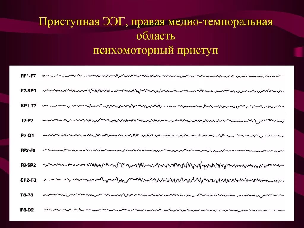 Эпилептиформная активность на ЭЭГ. Миоклонический приступ на ЭЭГ. Эпилептиформные разряды на ЭЭГ. Фокальная эпилепсия на ЭЭГ. Ээг тверь