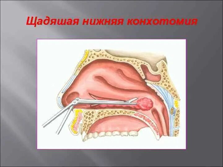 Что такое хронический ринит