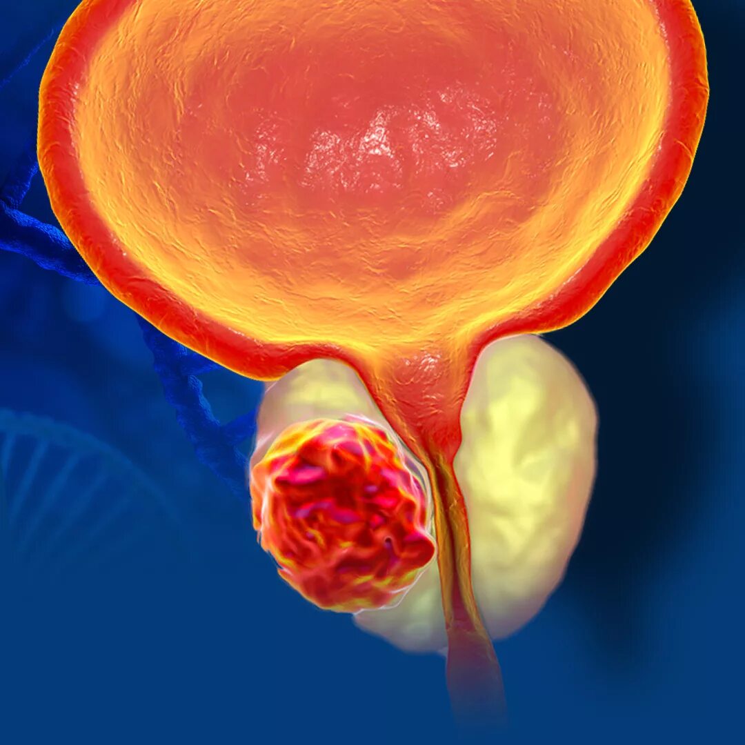 Воспалился простатит. Предстательная железа, Prostata. Простата и предстательная железа. Раковые клетки простаты. Воспаленная железа предстательная железа.