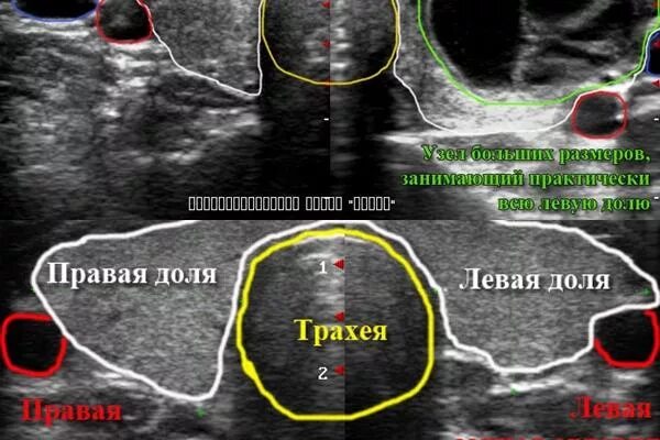 УЗИ щитовидной железы узел правой доли. УЗИ щитовидной железы узел левой доли. Щитовидная железа узлы в левой доле на УЗИ. Узловые образования долей щитовидной железы.