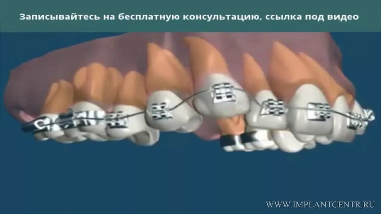Брекет системы проект