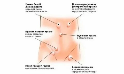 Грыжа передней стенки живота