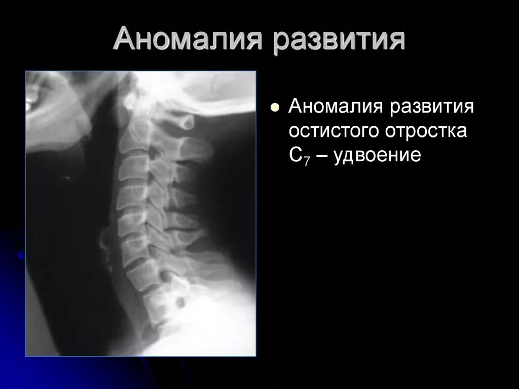 Расщепление остистого отростка с7. Аномалии развития позвонков поясничного отдела. Удвоение 1 остистого отростка шейного позвонка рентген. Неполная конкресценция тел позвонков с1-с2.