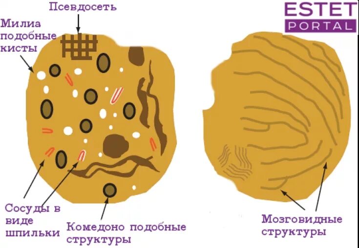 Кератомы лечение препараты отзывы. Кератомы лечение препараты отзывы