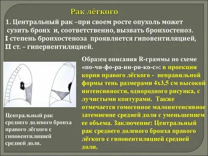 После операции рака легкого