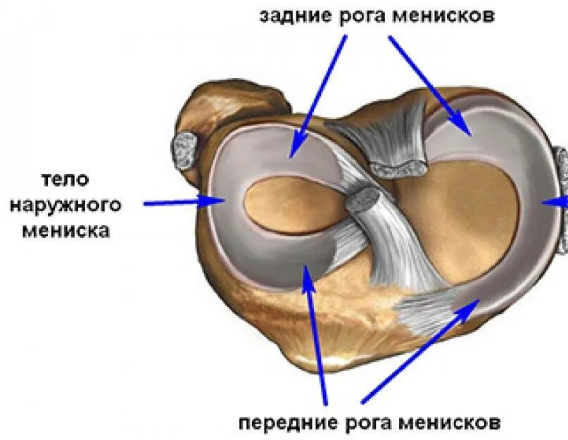 Менисцит медиального мениска коленного сустава что это. Медиальный мениск коленного сустава анатомия. Разрыв мениска артроскопичекски. Медиальный мениск продольный разрыв переднего рога. Поврежденный мениск коленного сустава