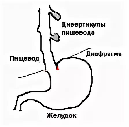 Дивертикулы пищевода и желудка. Псевдодивертикул пищевода. Тяжесть в пищеводе