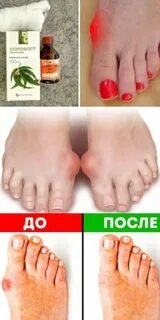 Избавиться от грибка навсегда