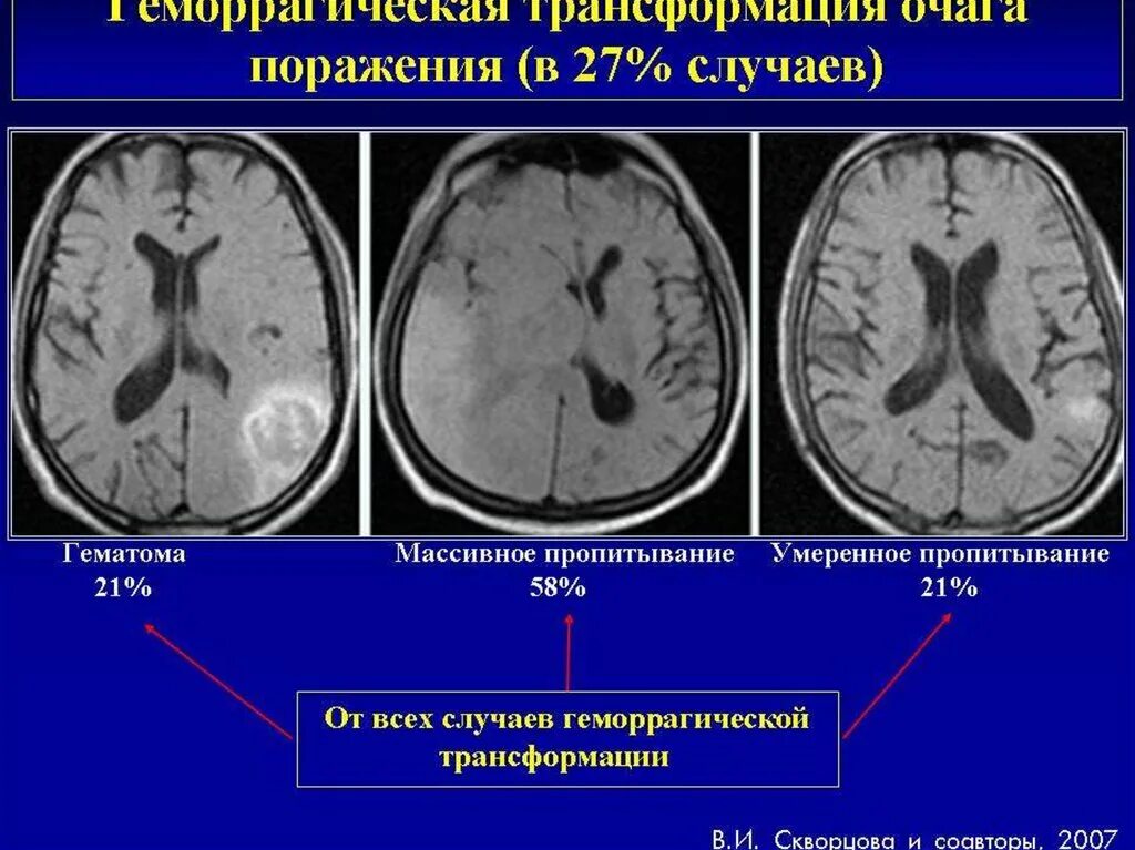 Геморрагическая трансформация ишемического инсульта типы. Типы геморрагической трансформации на кт. Геморрагическая трансформация головного мозга. Геморрагическая трансформация ишемического инсульта кт. Что такое ишемический инсульт головного мозга