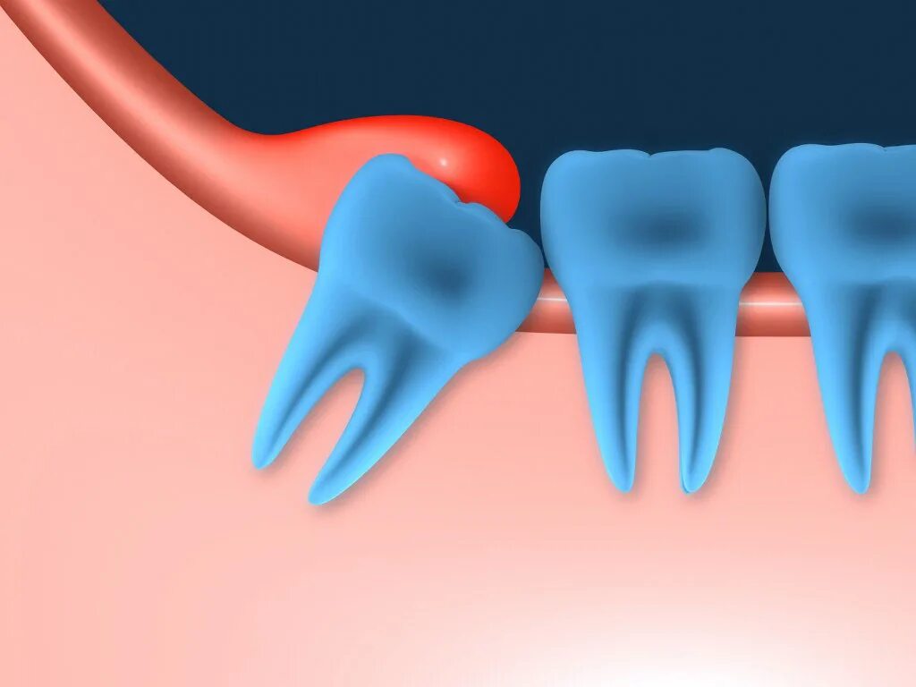 Tooth problems. Tooth problems