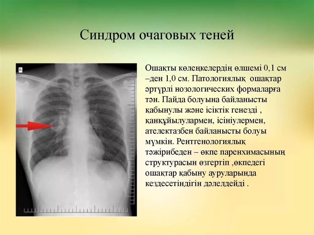 Округлое затемнение