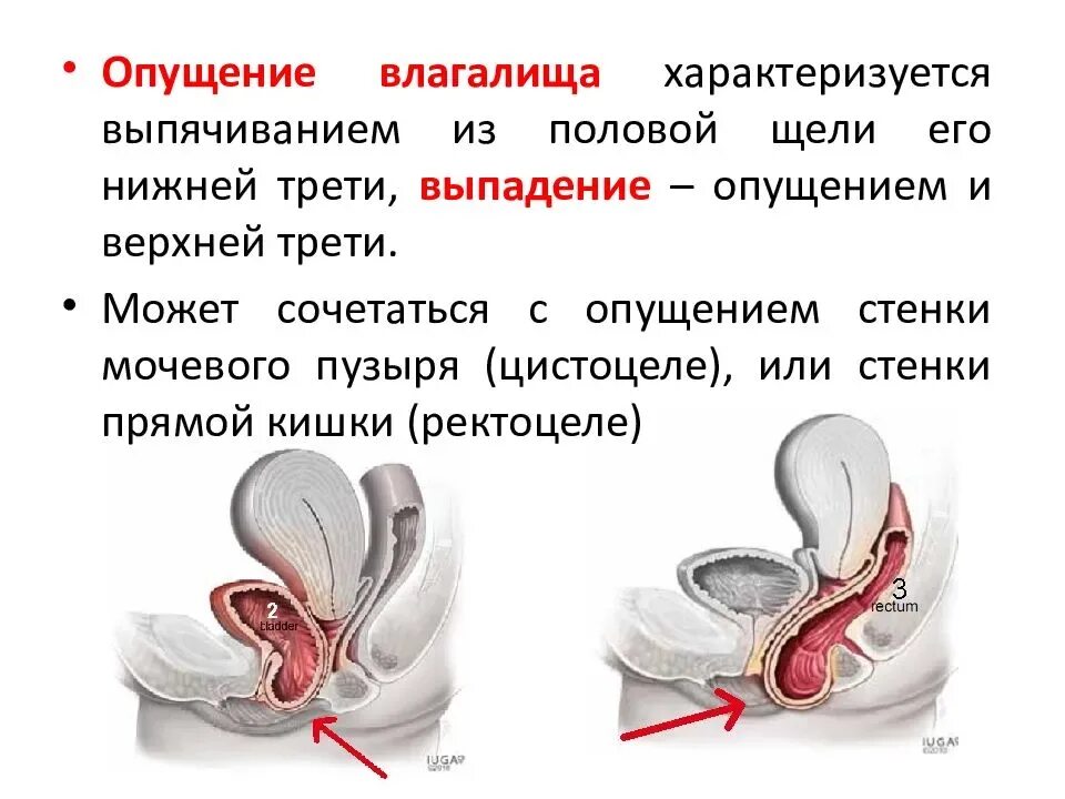 При опущении матки какие