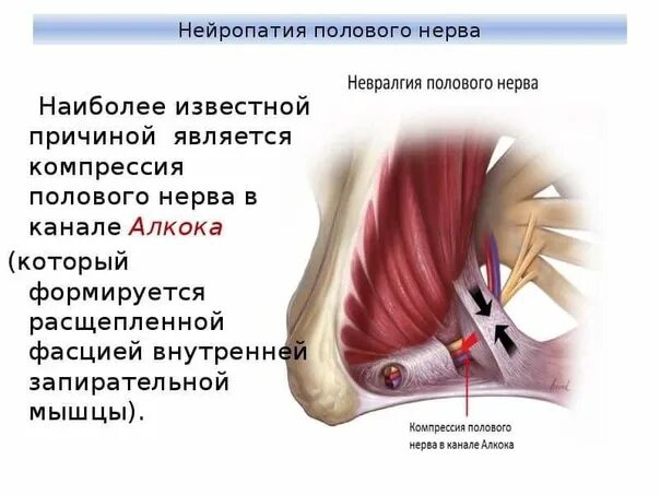 Невропатия полового нерва. Невралгия полового нерва. Нейропатия полового нерва. Невралгия бедренно-полового нерва.