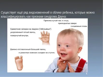 Синдром дауна мкб 10 у детей код