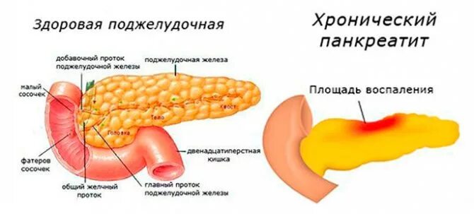 Поджелудочная железа лечение и питание взрослого. Хроническое воспаление поджелудочной железы. поражения поджелудочной железы иллюстрации. панкреатин поджелудочная железа.