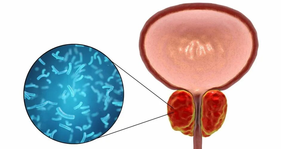 Хронический простатит народные. Острый бактериальный простатит. Возбудители простатита. Острый простатит урология.