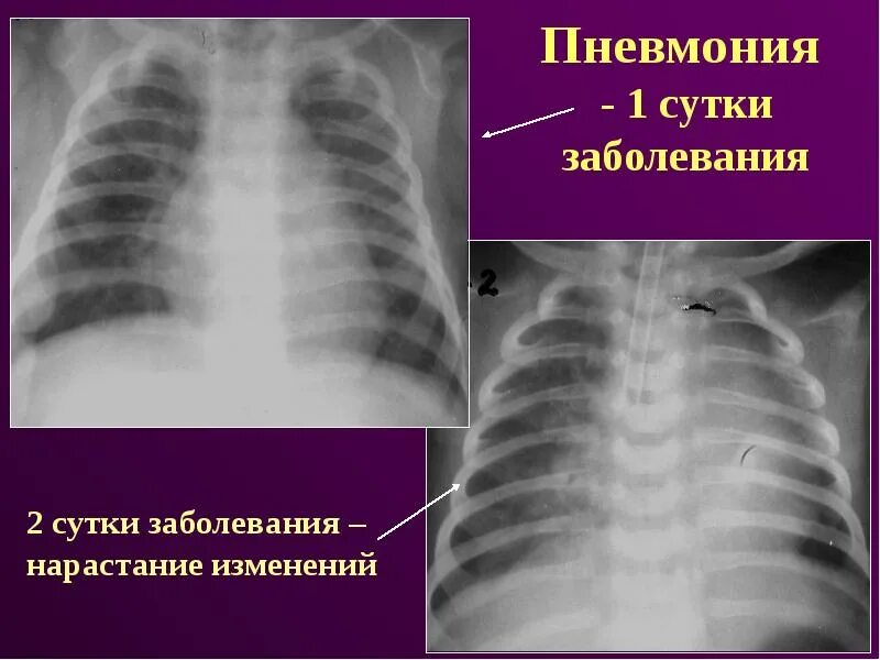 Тотальная левосторонняя пневмония рентген. Легкие двухстороннее. Легкие двухстороннее. Двухсторонняя пневмония. Легкие двухстороннее.