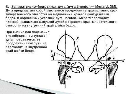 Углы тазобедренного сустава у детей