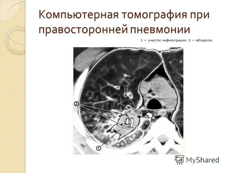 Пневмония на кт. Параканкрозная пневмония на кт. Матовое стекло на кт при коронавирусе. Степень тяжести пневмонии кт. Степени поражения легких.