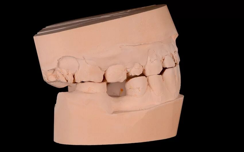 Изготовление гипсовой модели. Гипсовая модель зубов. Диагностические гипсовые модели. Диагностические гипсовые модели челюстей. Гипсовые модели в стоматологии.