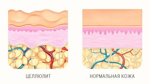 Жидкость подкожный жировой