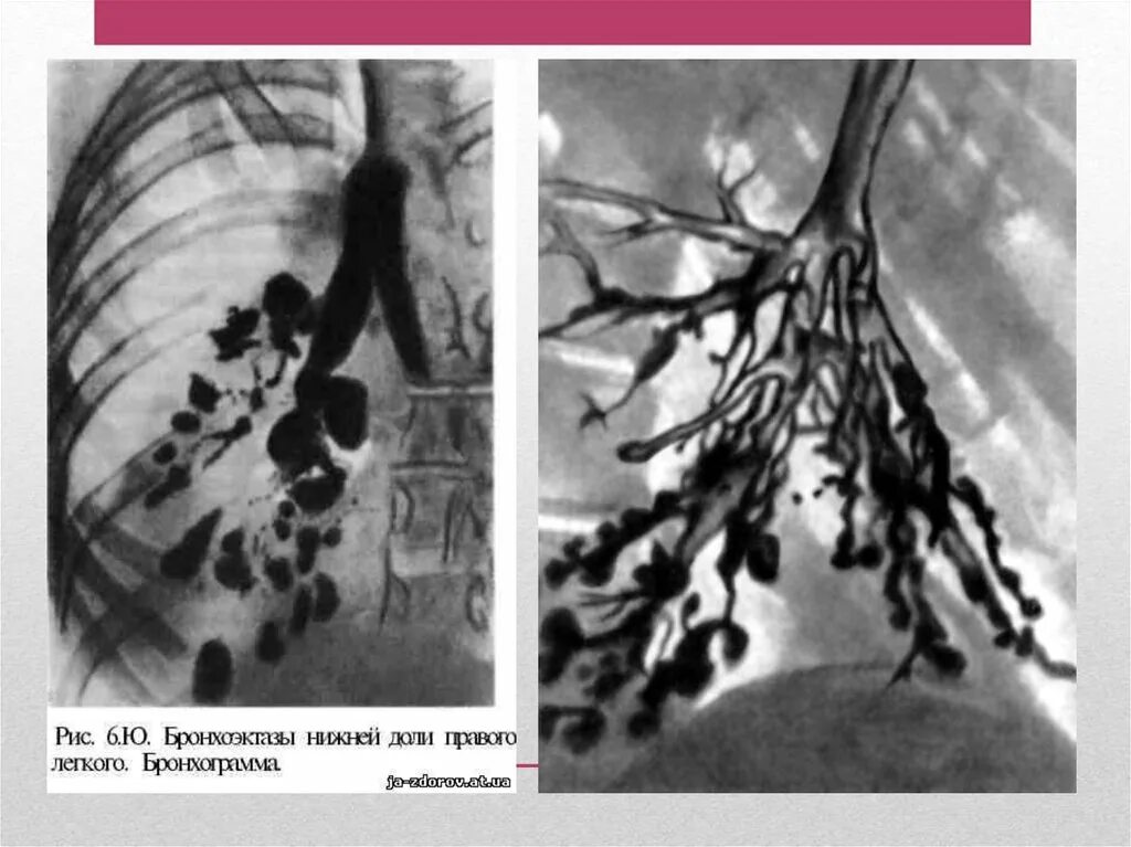 Бронхит бронхоэктатическая болезнь. Бронхография бронхоэктазы. Мешотчатые бронхоэктазы. Бронхоэктатическая болезнь мешотчатые бронхоэктазы. Бронхоэктатическая болезнь бронхография.