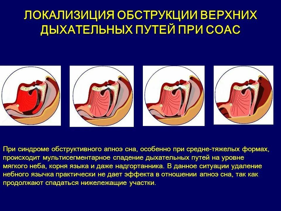 Обструкция верхних дыхательных путей. Обтурация верхних дыхательных путей. Непроходимость верхних дыхательных путей. Синдром обструктивного апноэ сна. Множественная локализация