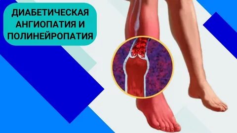 Ангиопатия нижних конечностей мкб 10