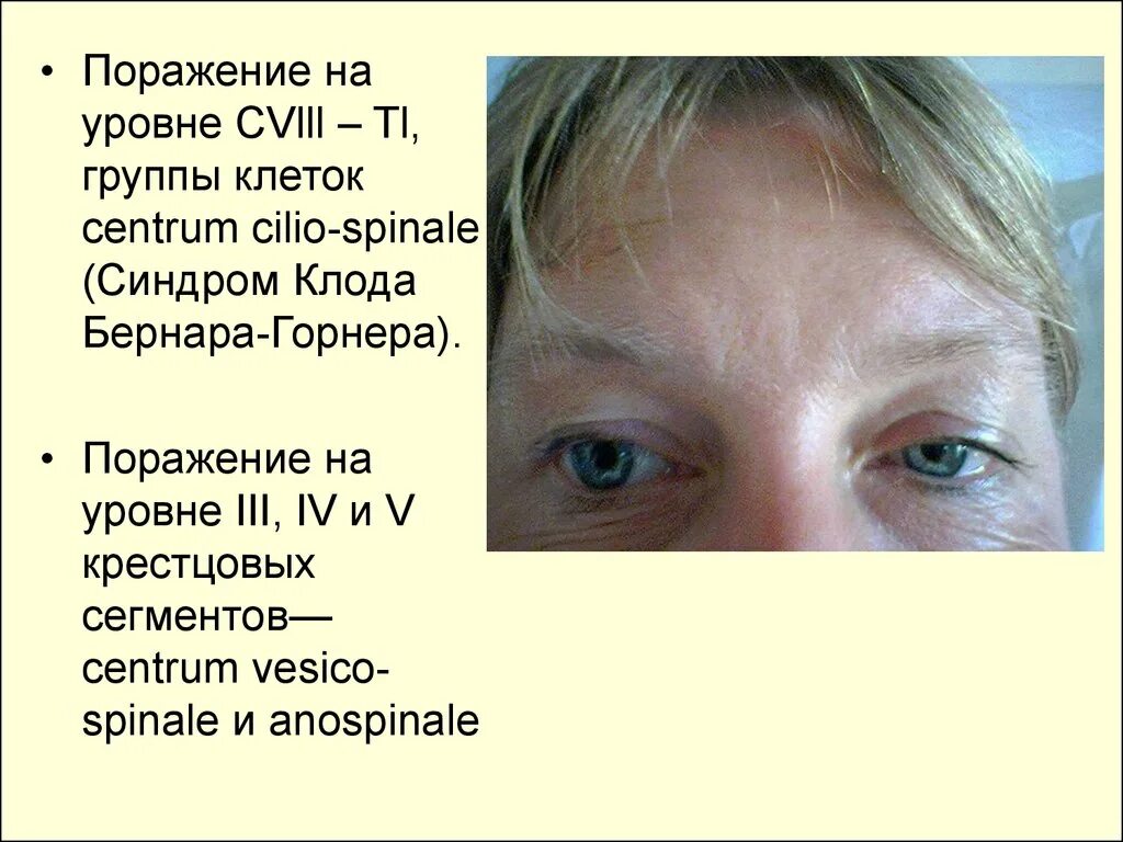 Синдром горнера это. Синдром горнера. синдром клода бернара горнера неврология. синдром горнера уровень поражения. синдром горнера бернара поражение сегмента.