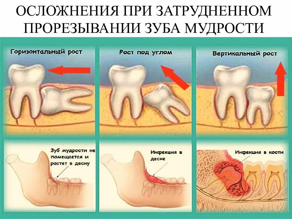 Можно ли греть зубы. Прорезывание зуба мудрости. Прореживание зуба мудрости. Зуб мудрости осложнения.