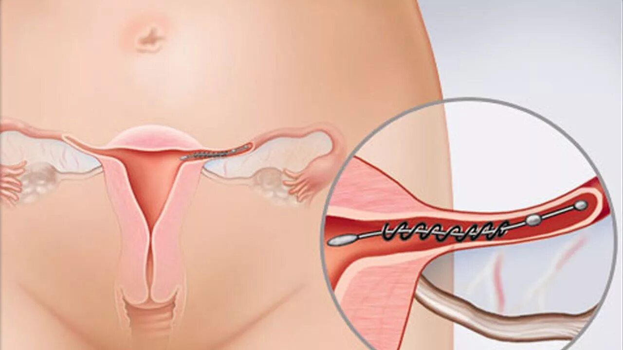 Как перевязывают трубы у женщин. Перевязка маточных труб. Что такое перевязка маточных труб у женщин.